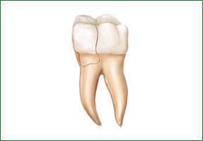 Cracked Teeth